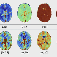 Clinically-Informed Preprocessing Improves Stroke Segmentation in Low-Resource Settings