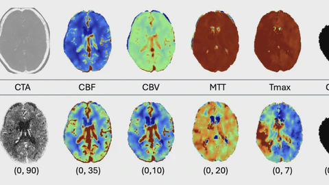 Clinically-Informed Preprocessing Improves Stroke Segmentation in Low-Resource Settings
