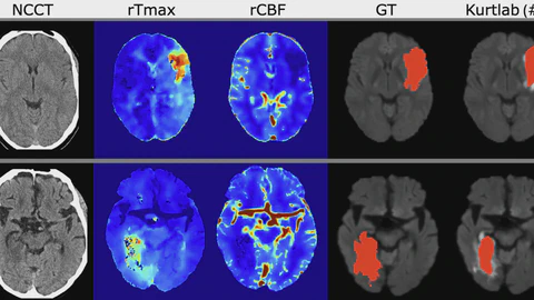 ISLES’24: Final Infarct Prediction with Multimodal Imaging and Clinical Data. Where Do We Stand?