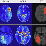ISLES’24: Final Infarct Prediction with Multimodal Imaging and Clinical Data. Where Do We Stand?