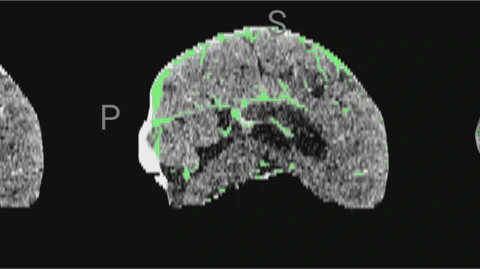 Clinically-Informed Preprocessing Improves Stroke Segmentation in Low-Resource Settings