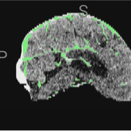 Clinically-Informed Preprocessing Improves Stroke Segmentation in Low-Resource Settings